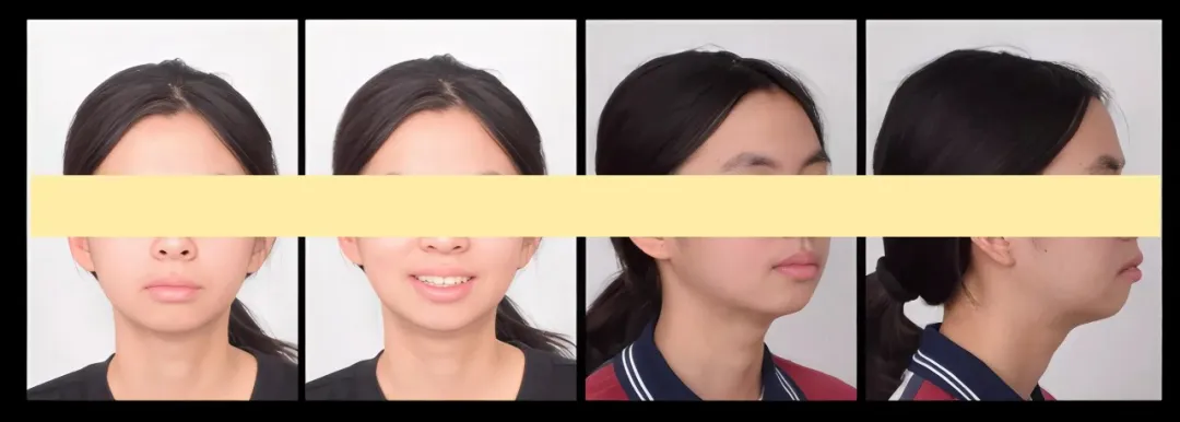 “龅牙”女孩的蜕变之旅：小美与汪品盈医生两年半的矫正故事！ 术后