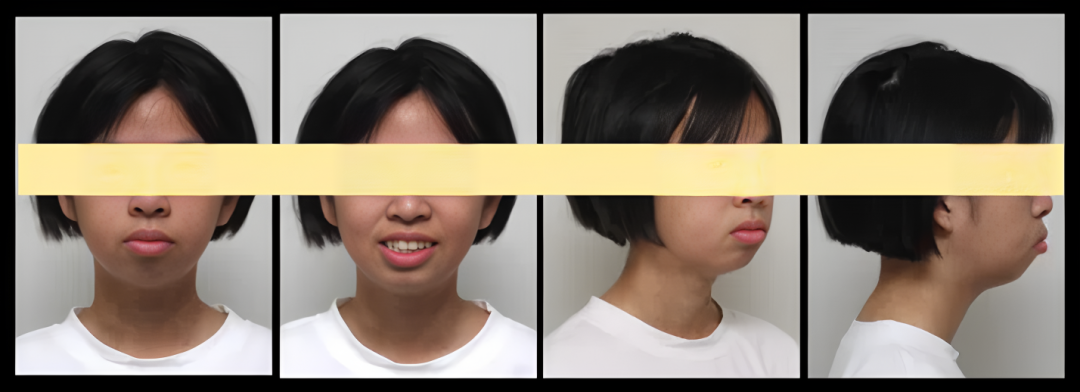 “龅牙”女孩的蜕变之旅：小美与汪品盈医生两年半的矫正故事！ 术前